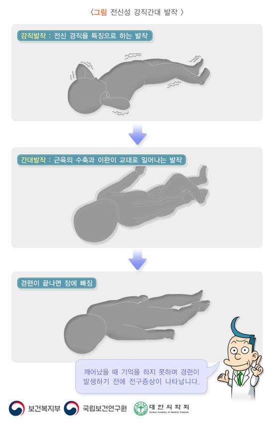 전신성 강직간대 발작
