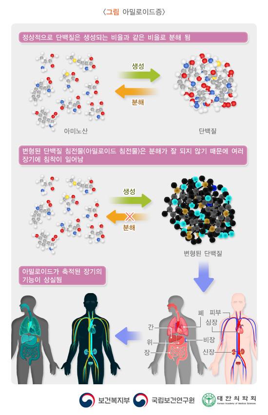 그림 아밀로이드증. 정상적으로 단백질은 생성되는 비율과 같은 비율로 분해됨. 아미노산> 생성> 단백질> 분해> 아미노산. 변형된 단백질 침전물(아밀로이드 침전물)은 분해가 잘 되지 않기 때문에 여러 장기에 침착이 일어남. 아밀로이드> 생성> 변형된 단백질 (분해x) > 아밀로이드가 축적된 장기의 기능이 상실됨 (폐, 간, 위, 비장, 장, 피부, 심장, 신장). 보건복지부, 국립보건연구원, 대한의학회