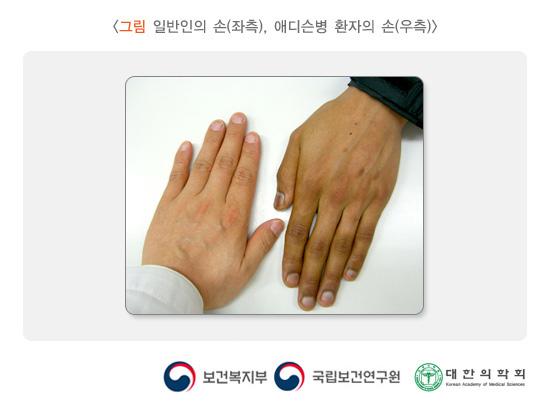 일반인의 손(좌측), 애디슨병 환자의 손(우측)