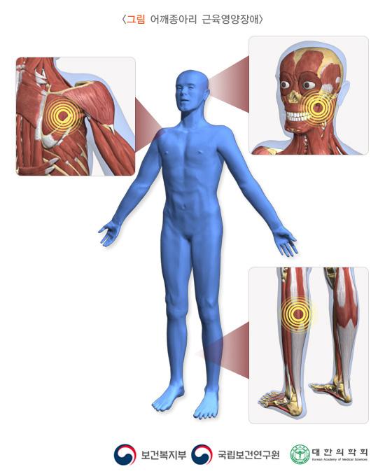 어깨종아리 근육영양장애