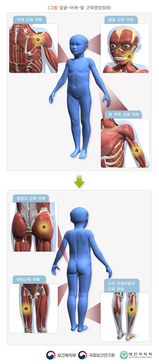 얼굴-어깨-팔 근육영양장애