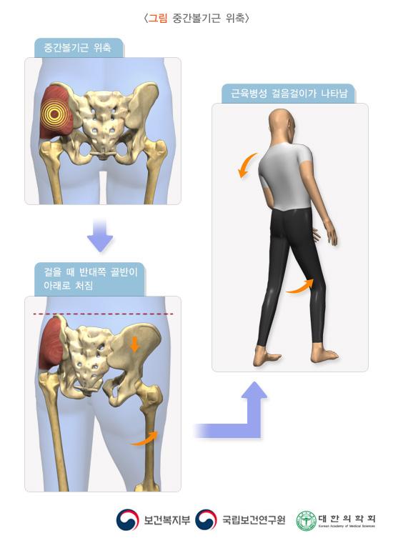 중간볼기근 위축
