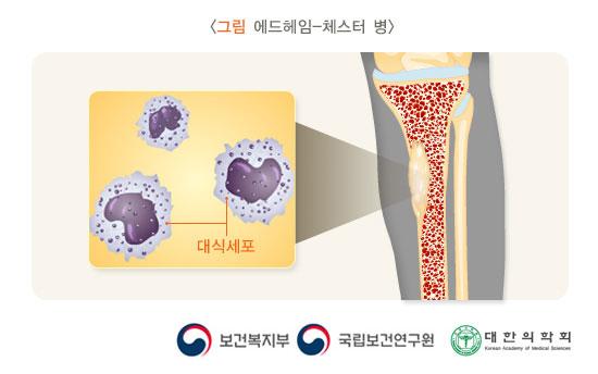 에드하임-체스터 병: 대식세포가 뼈에 침투한 그림