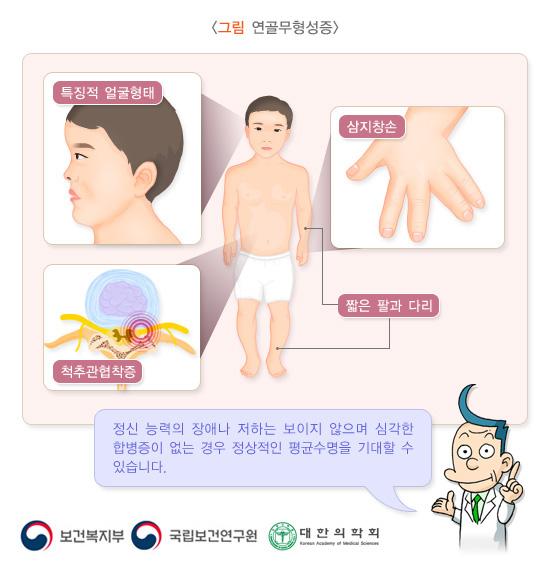 연골무형성증
