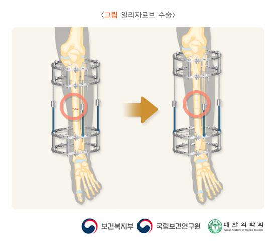 일리자로브 수술