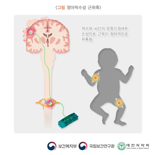 영아척수성 근위축
