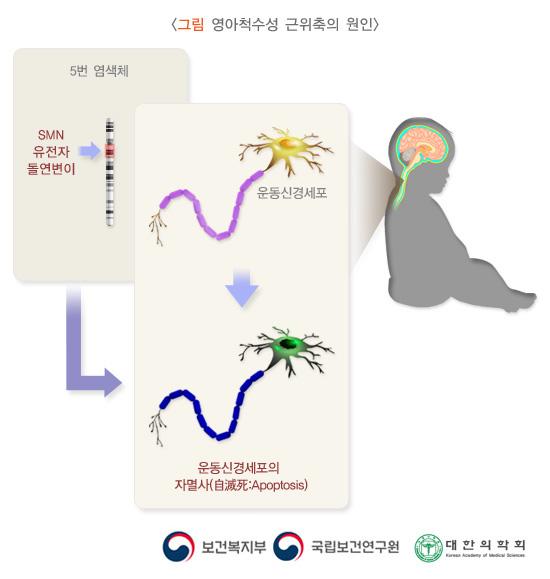 영아척수성 근위축의 원인