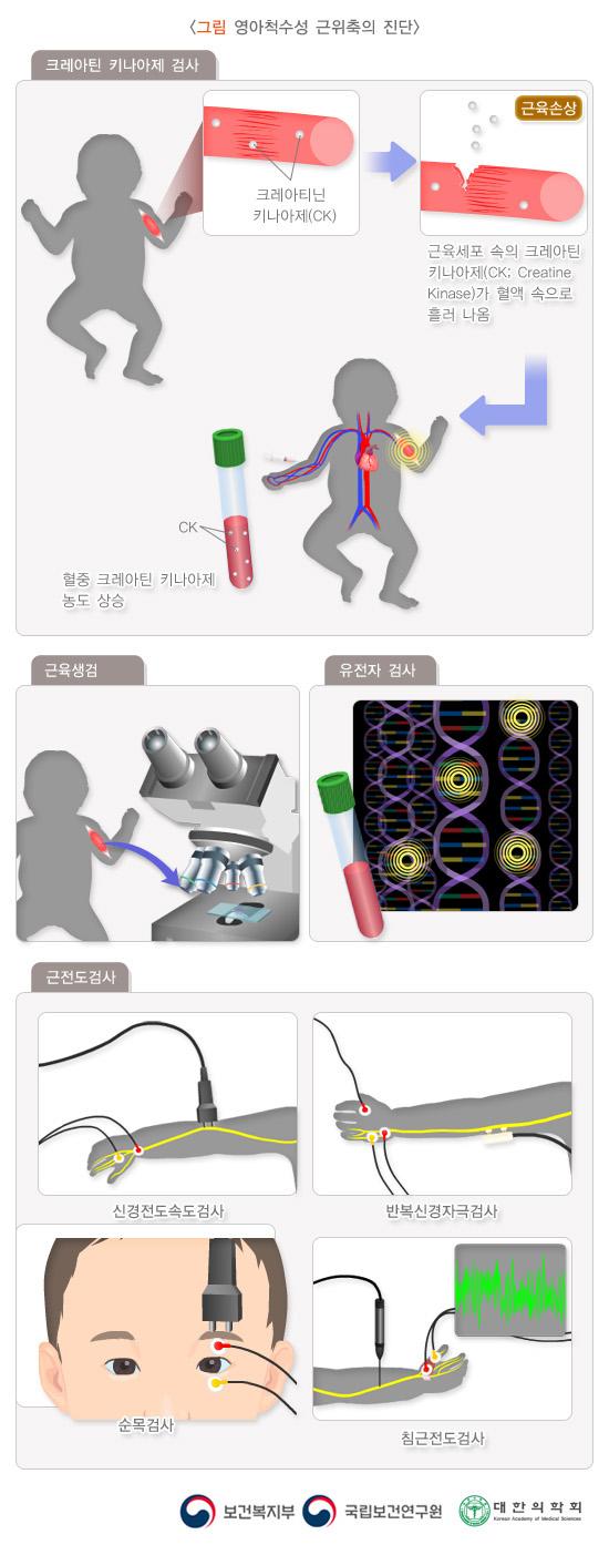 영아척수성 근위축의 진단