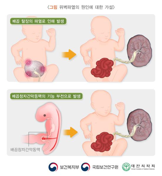 위벽파열의 원인에 대한 가설