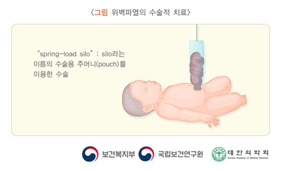 위벽파열의 수술적 치료