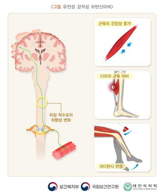 유전성 강직성 하반신마비
