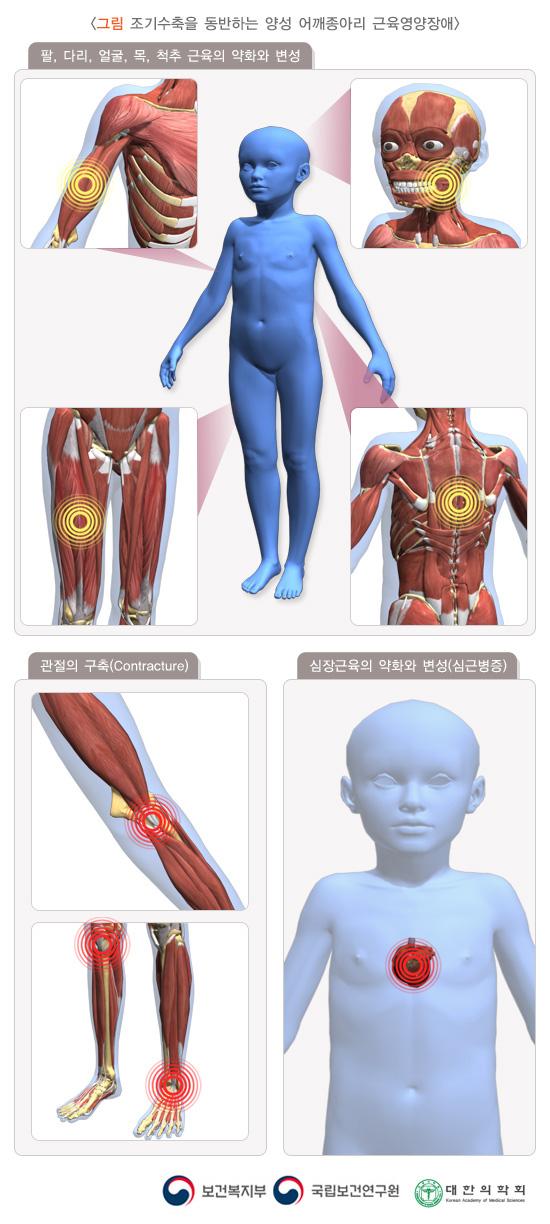 조기수축을 동반하는 양성 어깨종아리 근육영양장애