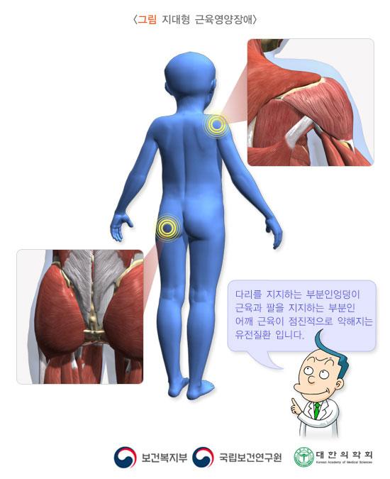 지대형 근육영양장애