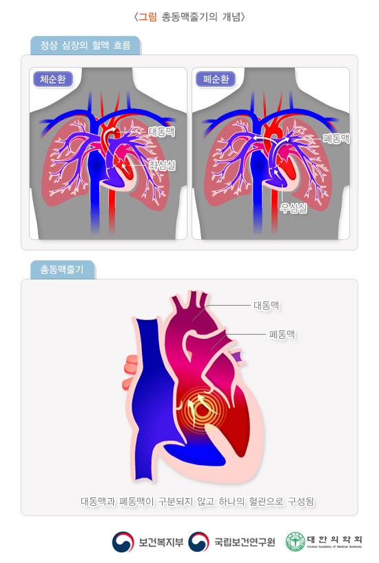 총동맥줄기의 개념