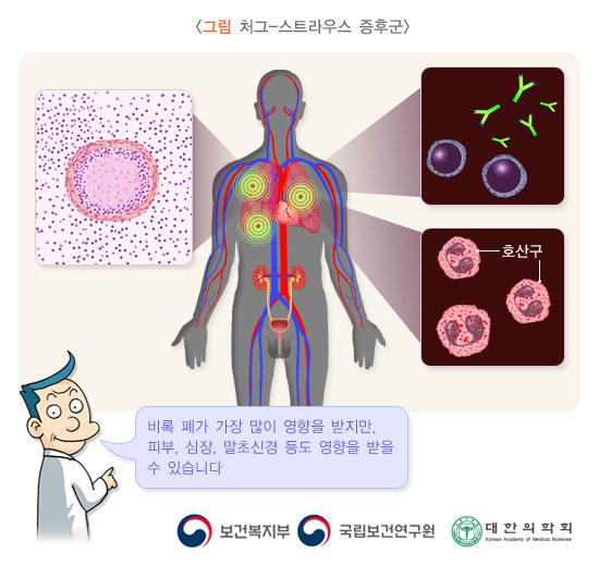 스트라우스 증후군