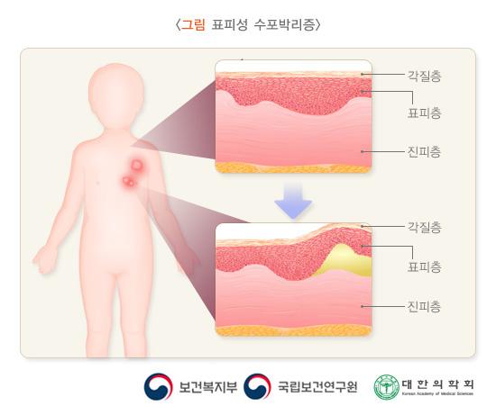 수포성 표피박리증
