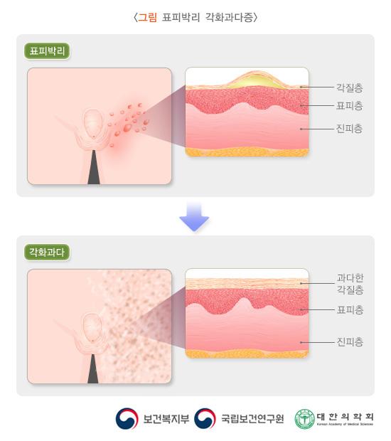 표피박리 각화과다증