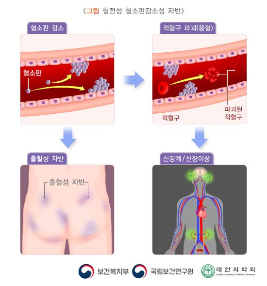 혈전성 혈소판감소성 자반