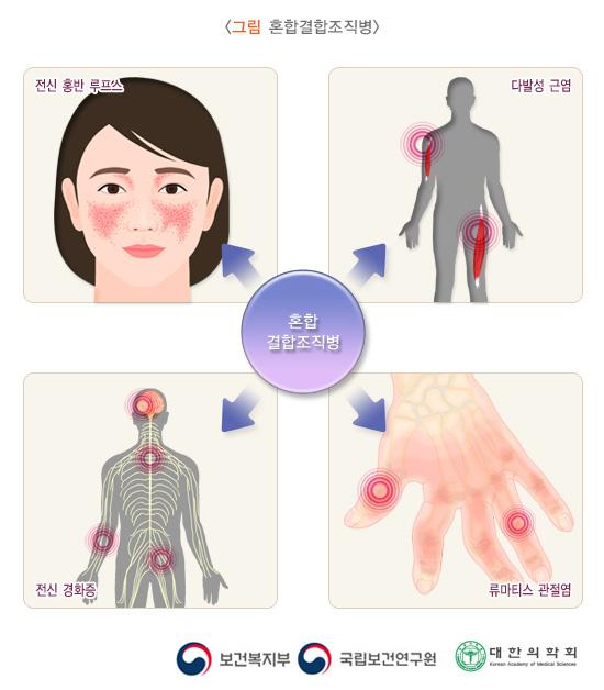 혼합결합조직병