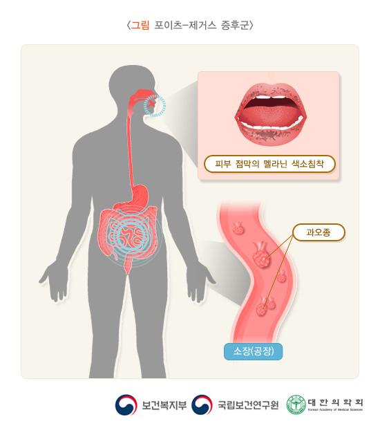 포이츠-제거스 증후군