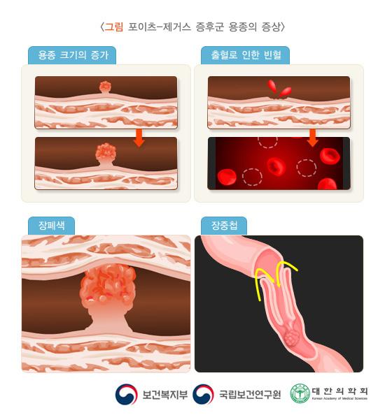 포이츠-제거스 증후군 용종의 증상
