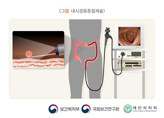 내시경용종절제