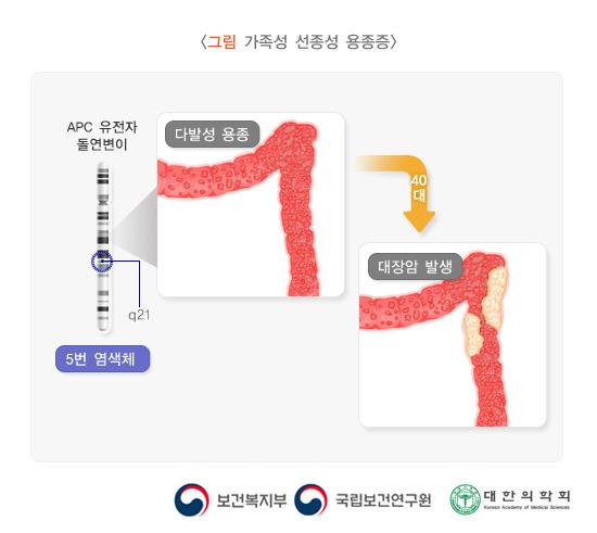 그림 가족성 선종성 용종증. APC 유전자 돌연변이 5번염색체 q21. 다발성 용종 > 40대 > 대장암 발생. 보건복지부, 국립보건연구원, 대한의학회