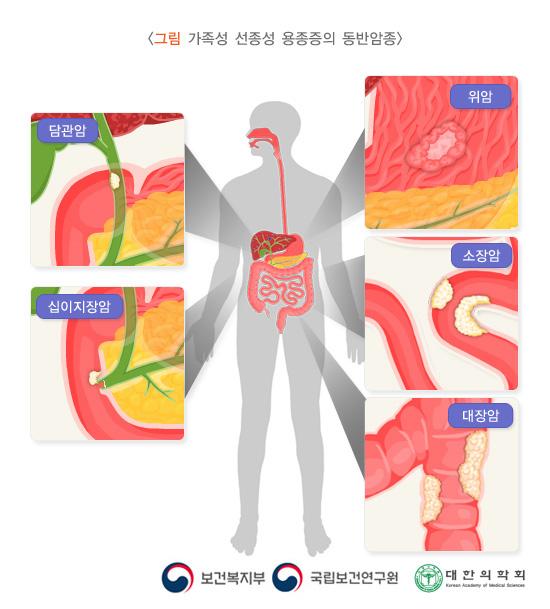 그림 가족성 선종성 용종증의 동반암종. 담관암, 십이지장암, 위암, 소장암, 대장암. 보건복지부, 국립보건연구원, 대한의학회.
