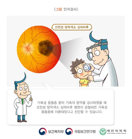 그림 안저검사. 선천성 망막색소 상피비후. 가족성 용종증 환자 가족의 망막을 검사하였을 때 선천성 망막색소 상피비후 병젼이 관찰되면 가족성 용종증에 이환되었다고 진단할 수 있습니다. 보건복지부, 국립보건연구원, 대한의학회