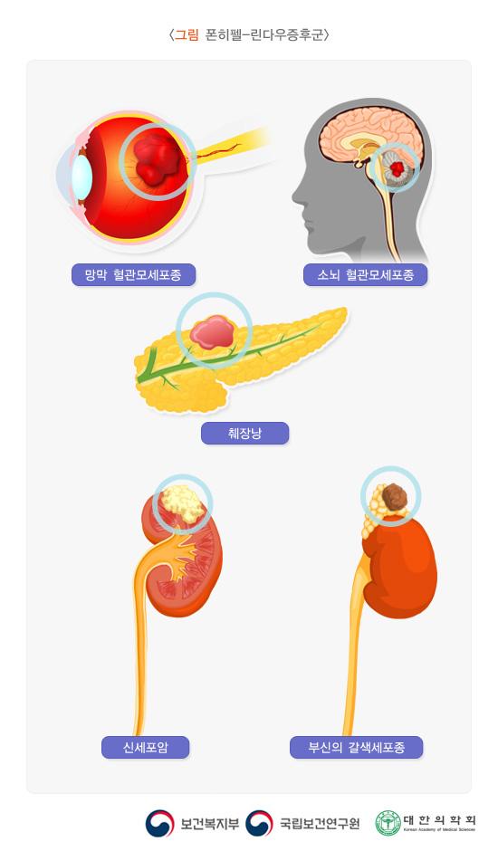 폰히펠-린다우증후군
