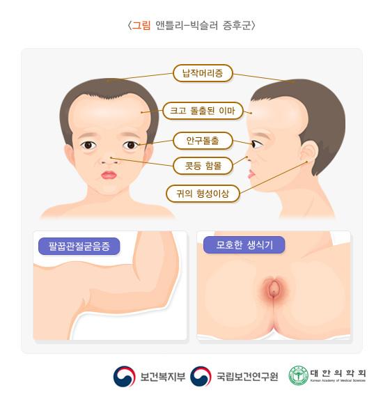 앤틀리-빅슬러 증후군의 특징적 그림: 납작머리증, 크고 돌출된 이마, 안구돌출, 콧등 함몰, 귀의 형성이상, 팔꿉관절굳음증, 모호한 생식기