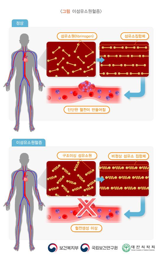 이섬유소원혈증