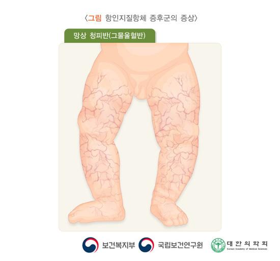 항인지질항체 증후군의 증상