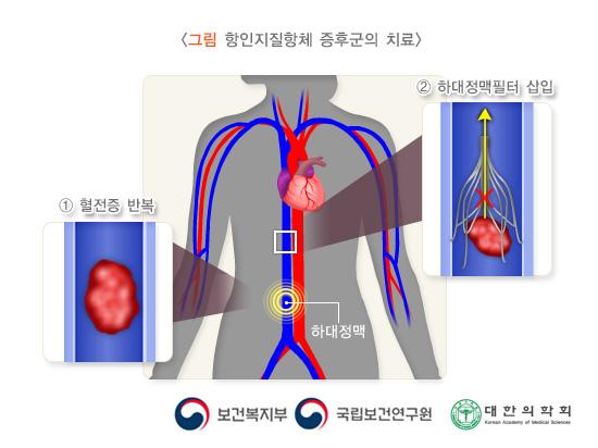 항인지질항체 증후