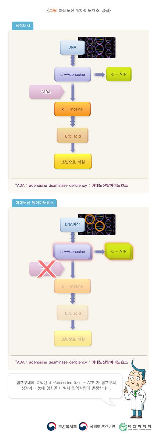 아데노신 탈아미노효소 결핍