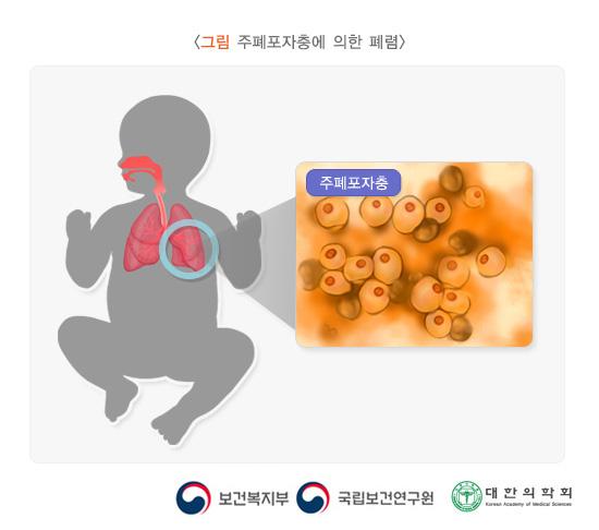주폐포자충에 의한 폐렴