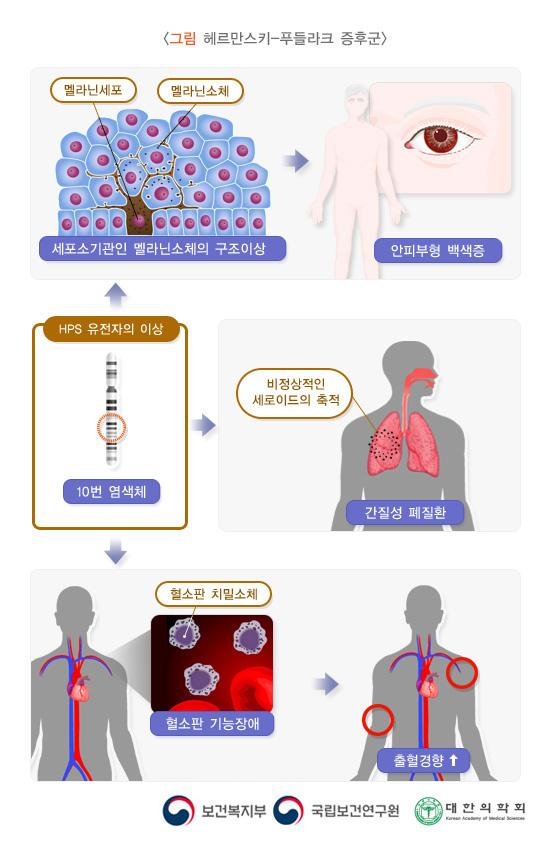 헤르만스키-푸들라크-증후군
