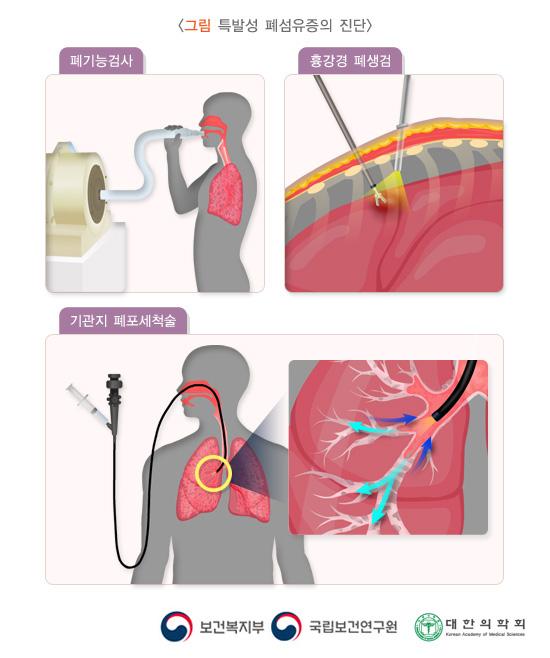 특발성 폐섬유증의 진단방법 이미지. 폐기능 검사, 흉강경 폐생검, 기관지 폐포세척술. 보건복지부, 국립보건연구원, 대한의학회