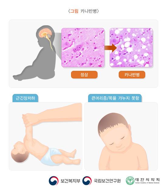 카나반병: 근긴장저하, 큰머리증/목을 가누지 못함
