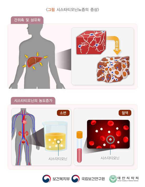 시스타티오닌뇨증의 증상