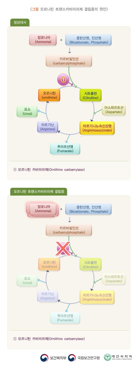 오르니틴 트랜스카비미라제 결핍증의 원인