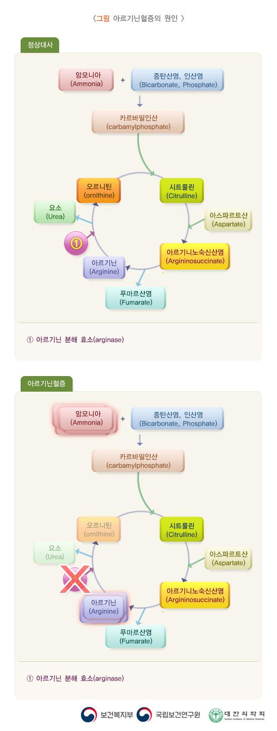 아르기닌혈증의 원인