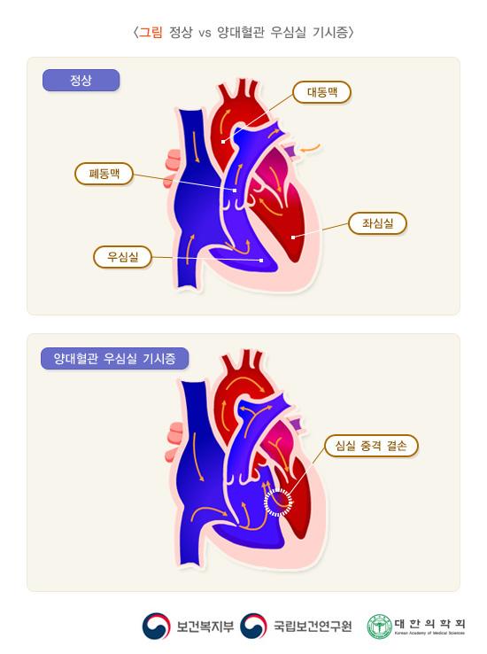 정상 vs 양대혈관 우심실 기시증