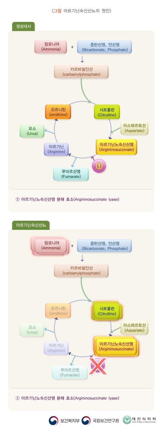 아르기닌숙신산뇨의 원인