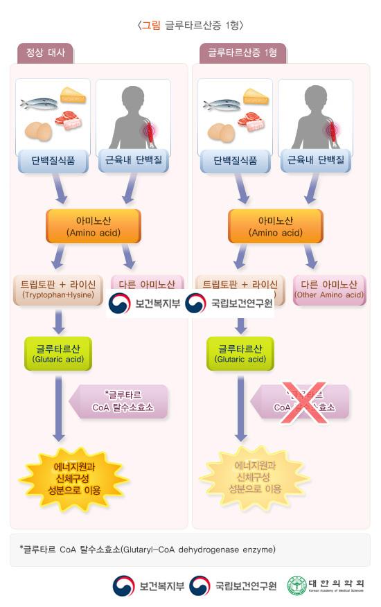 글루타르산증 1형