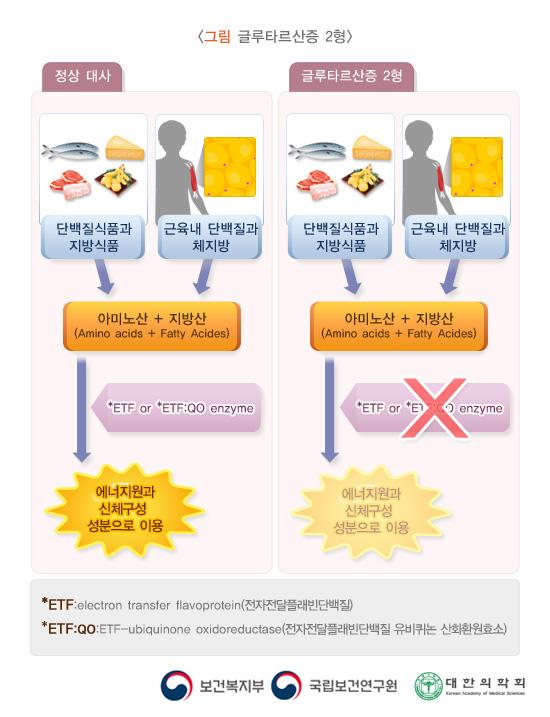 글루타르산증 2형