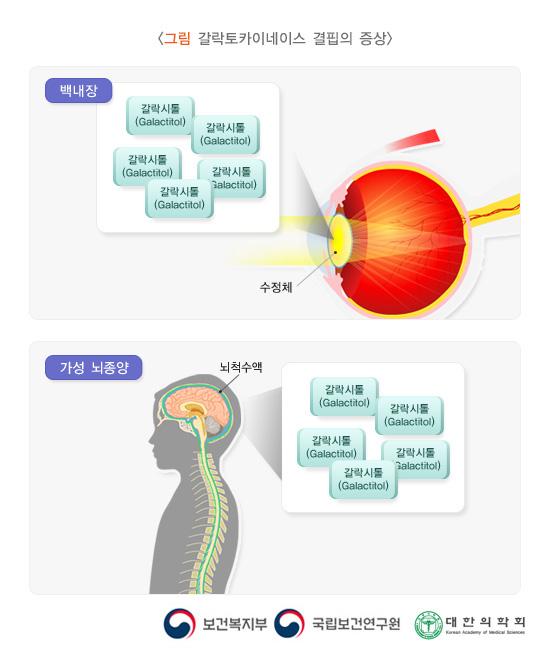 갈락토카이네이스 결핍의 증상
