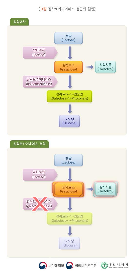 갈락토카이네이스 결핍의 원인