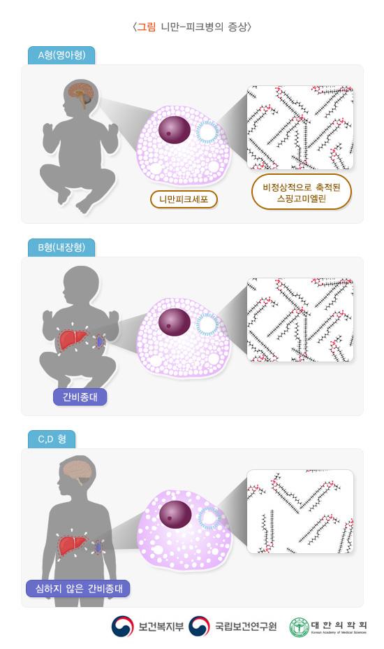 니만-피크병의 증상