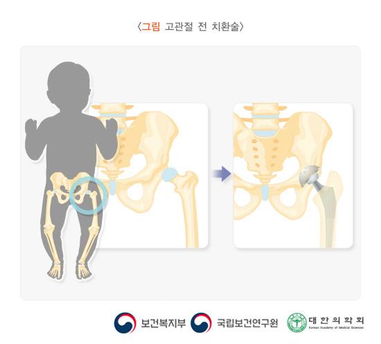 고관절전치환술
